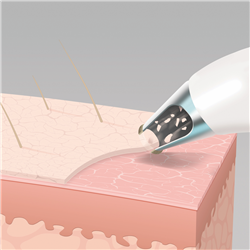 Homedics Radiance Microdermabrasion with Cooling